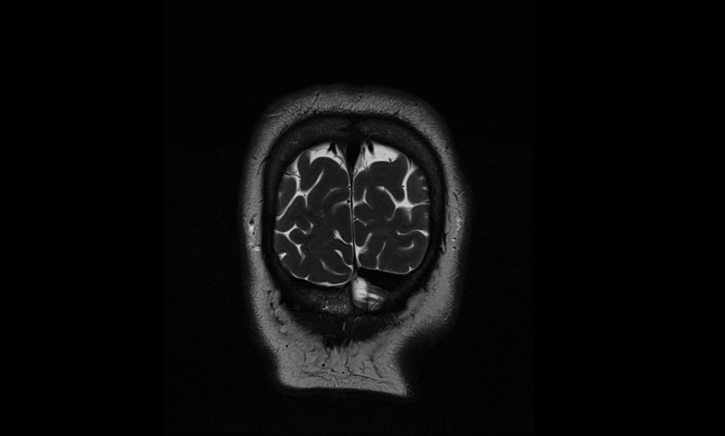 Brain cisterns  and ventricles coronal anatomy 3T MRI image-img-00001-00060.webp